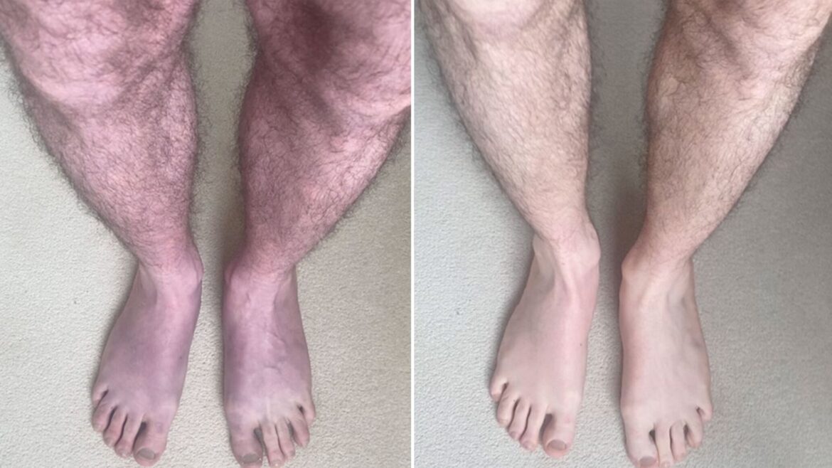 Unusual case of long COVID turns man’s legs blue after 10 minutes of standing up