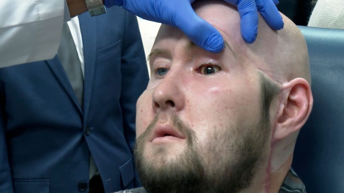 World’s first whole-eye transplant hailed as breakthrough